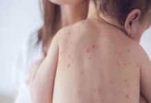 Рязко увеличение на болните от варицела от началото на годината